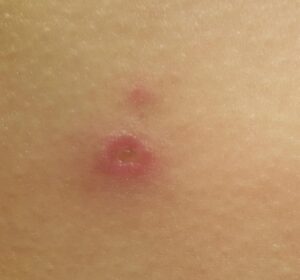 Skin with spider bite healing. Wound is getting amaller.